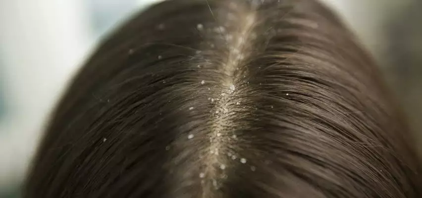 kaşıntılı saç derisi ve kepekten nasıl kurtulunur