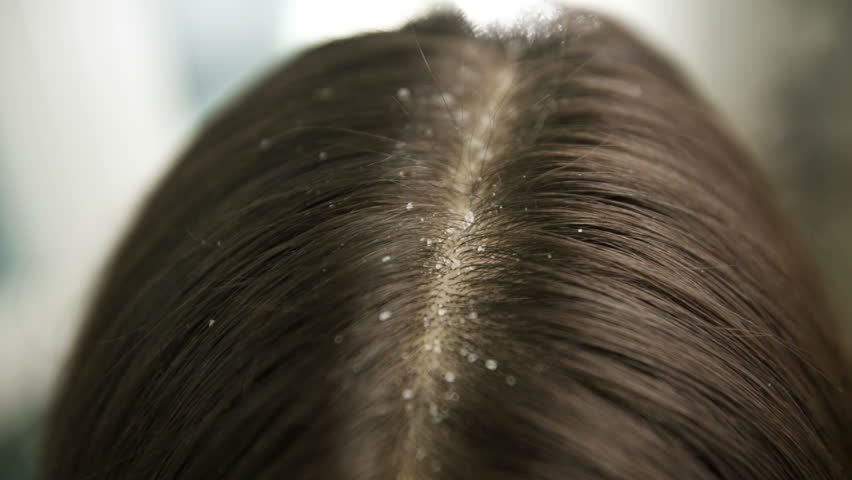 kaşıntılı saç derisi ve kepekten nasıl kurtulunur